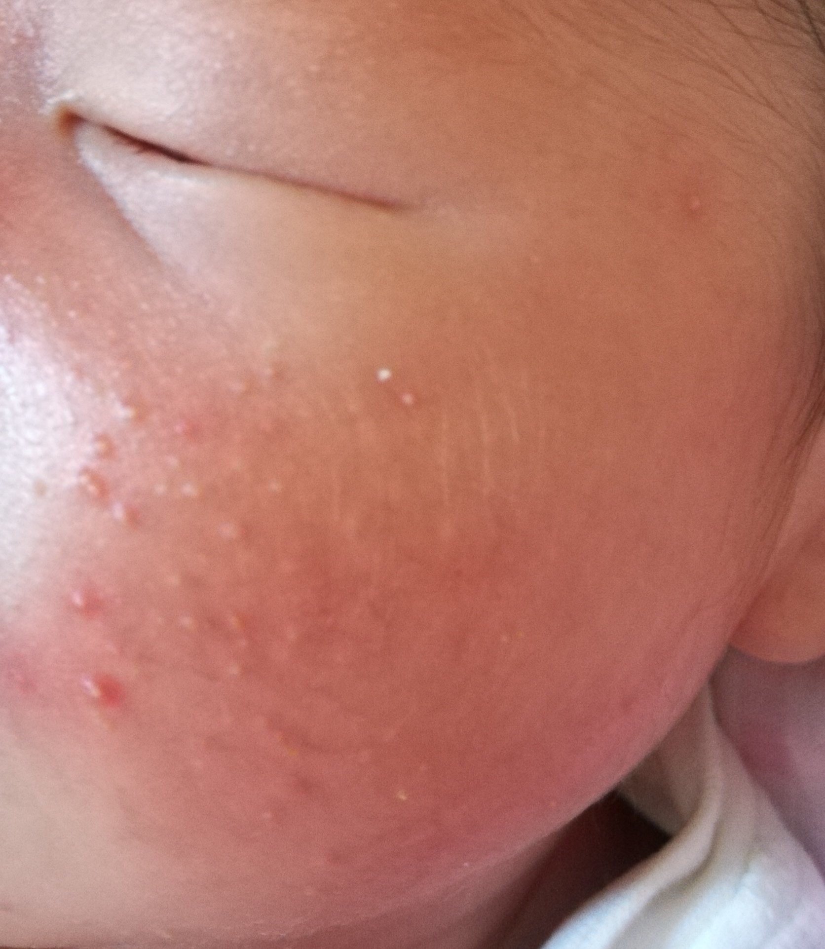 婴儿湿疹虽然常见,但要注意区分【新生儿痤疮/婴儿痤疮】  如图所示