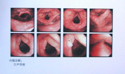 纤维喉镜检查:左 声带肿物 图像