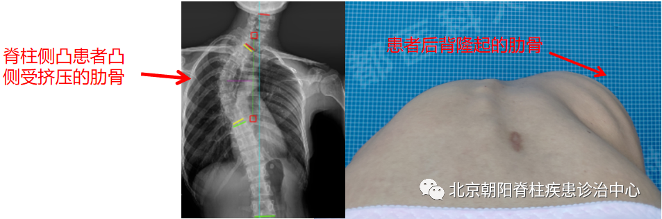 子,如果畸形的弯曲超过45°,如果出现了明显的胸廓前方和后方的变化