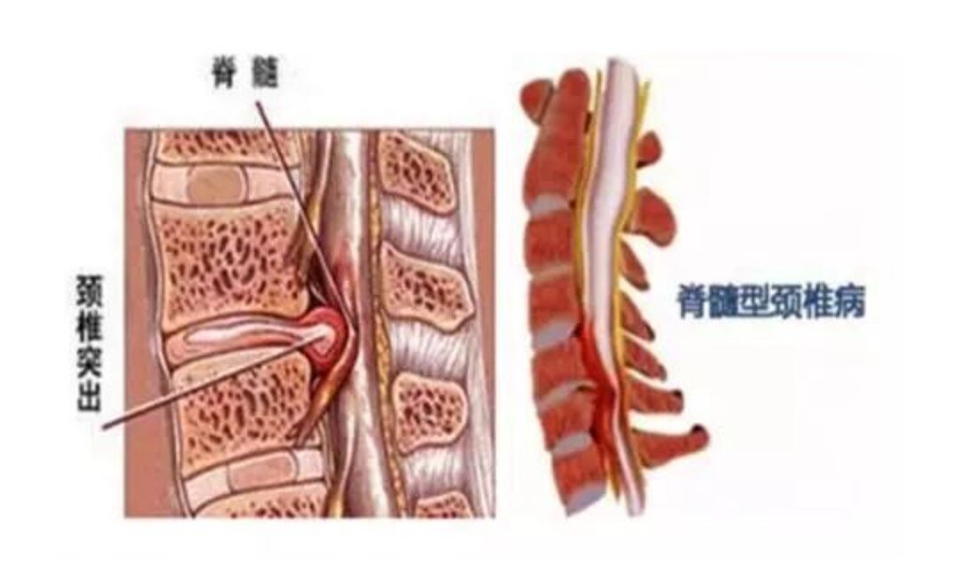 脊髓型颈椎病切莫大意推拿按摩治疗