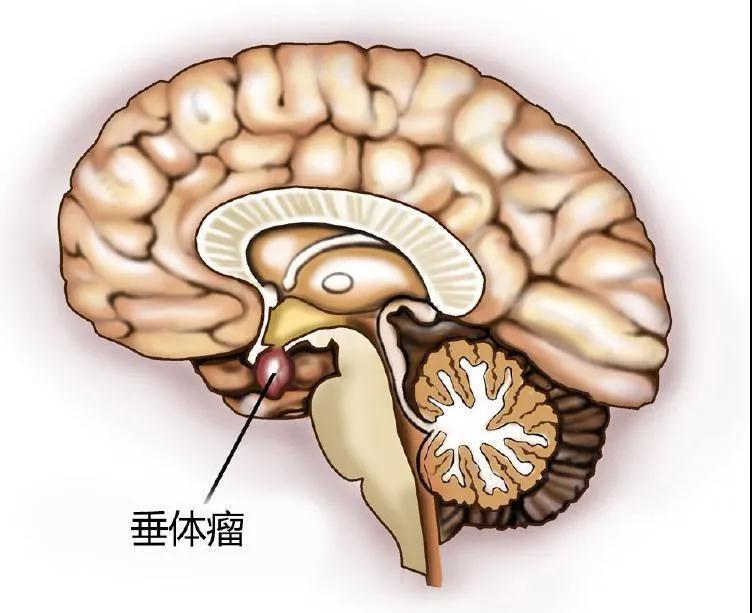 垂体瘤不需要开颅也能手术是的来看看神经内镜下经鼻蝶微创手术