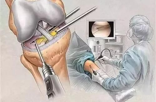 膝 关节镜 手术能做什么?