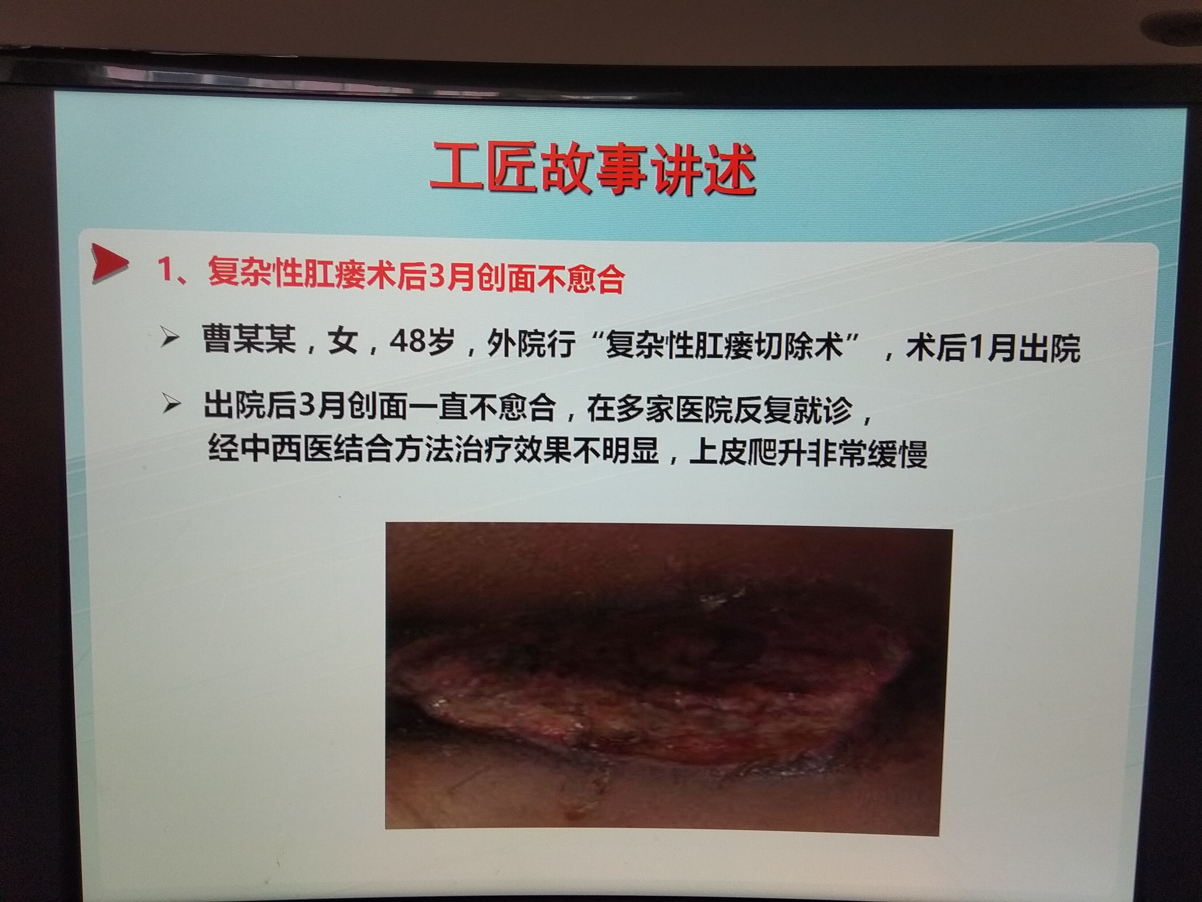 复杂性肛瘘术后伤口久不愈合,采用我院上海市非物质文化遗产"敛痔散"