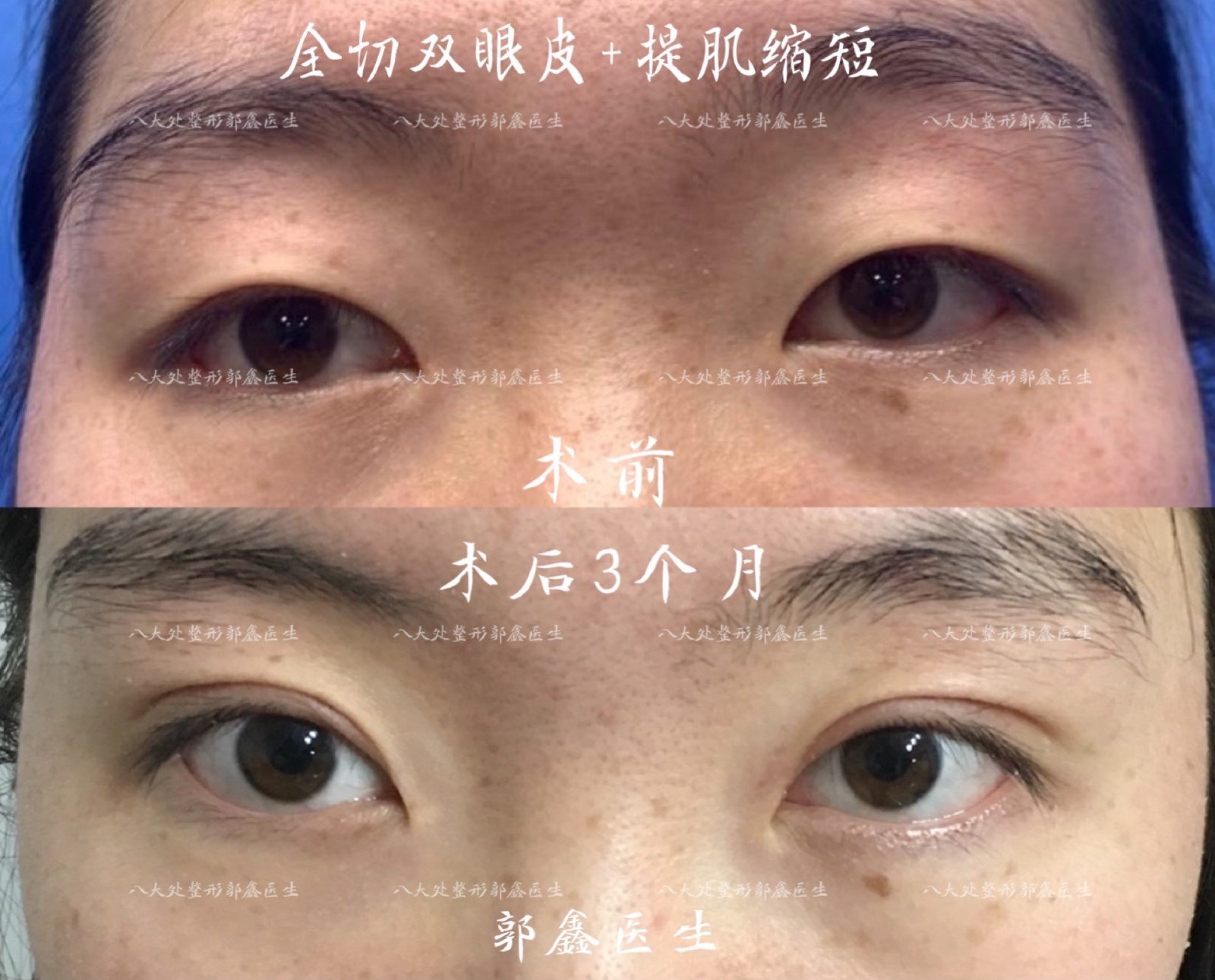 全切双眼皮,开内外眼角,提肌缩短(郭鑫医生)