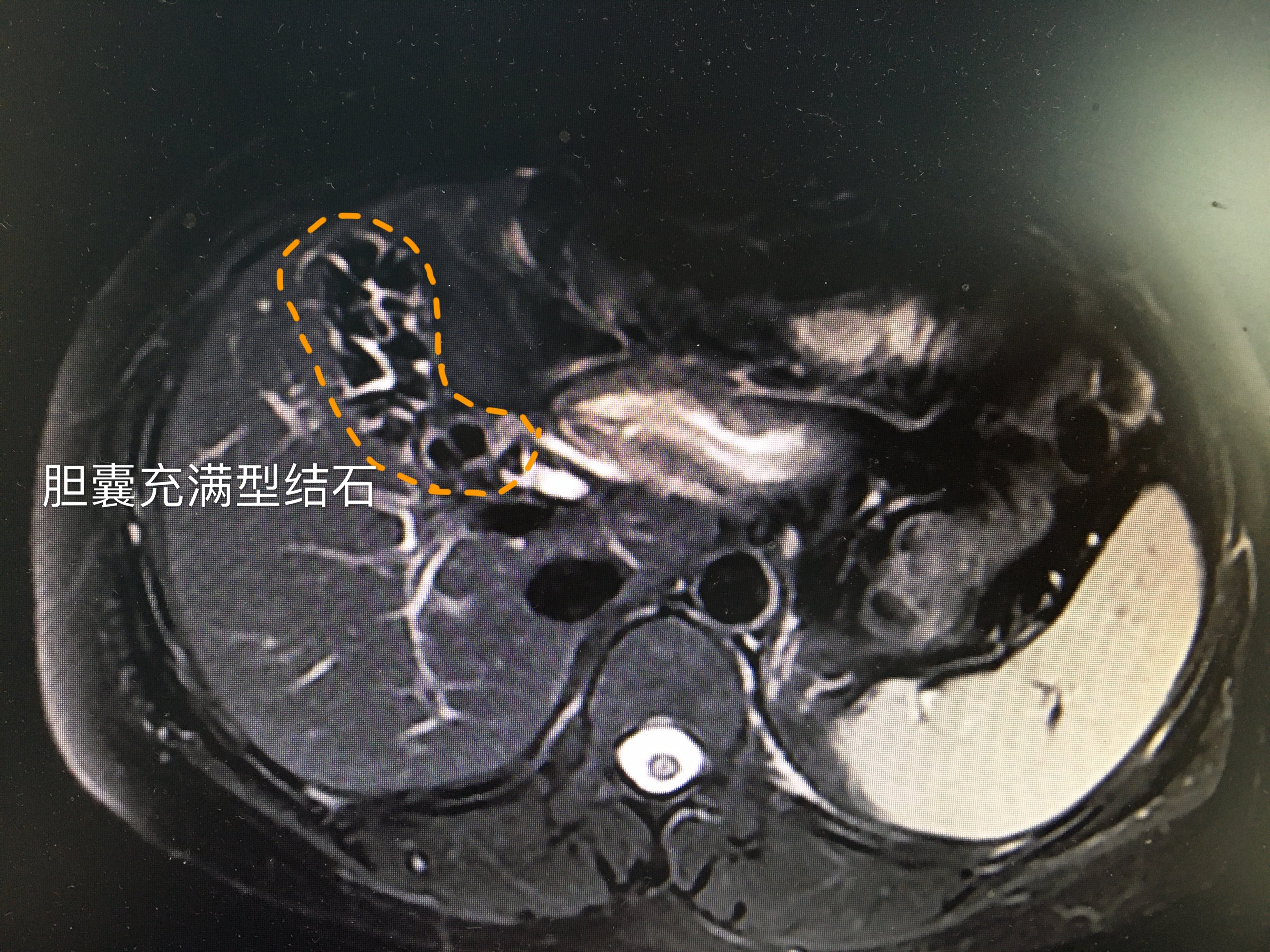 充满型胆囊结石建议尽早手术