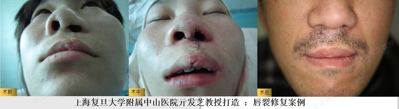 唇裂二期修复手术前后案例