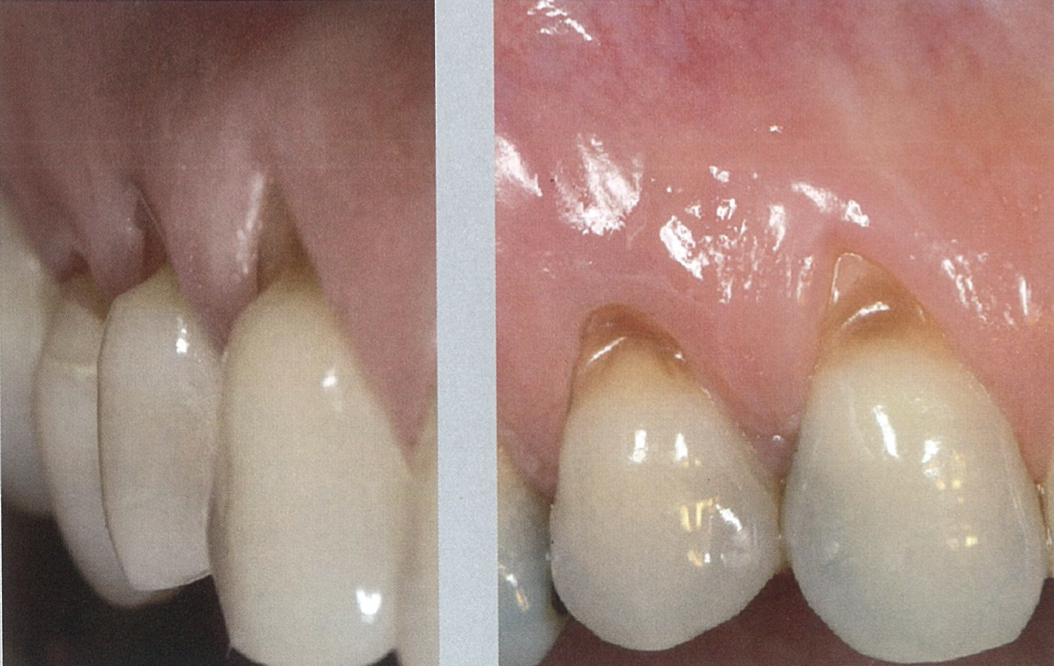 牙龈萎缩是怎么来的？定期洗牙每年定期一次一次！