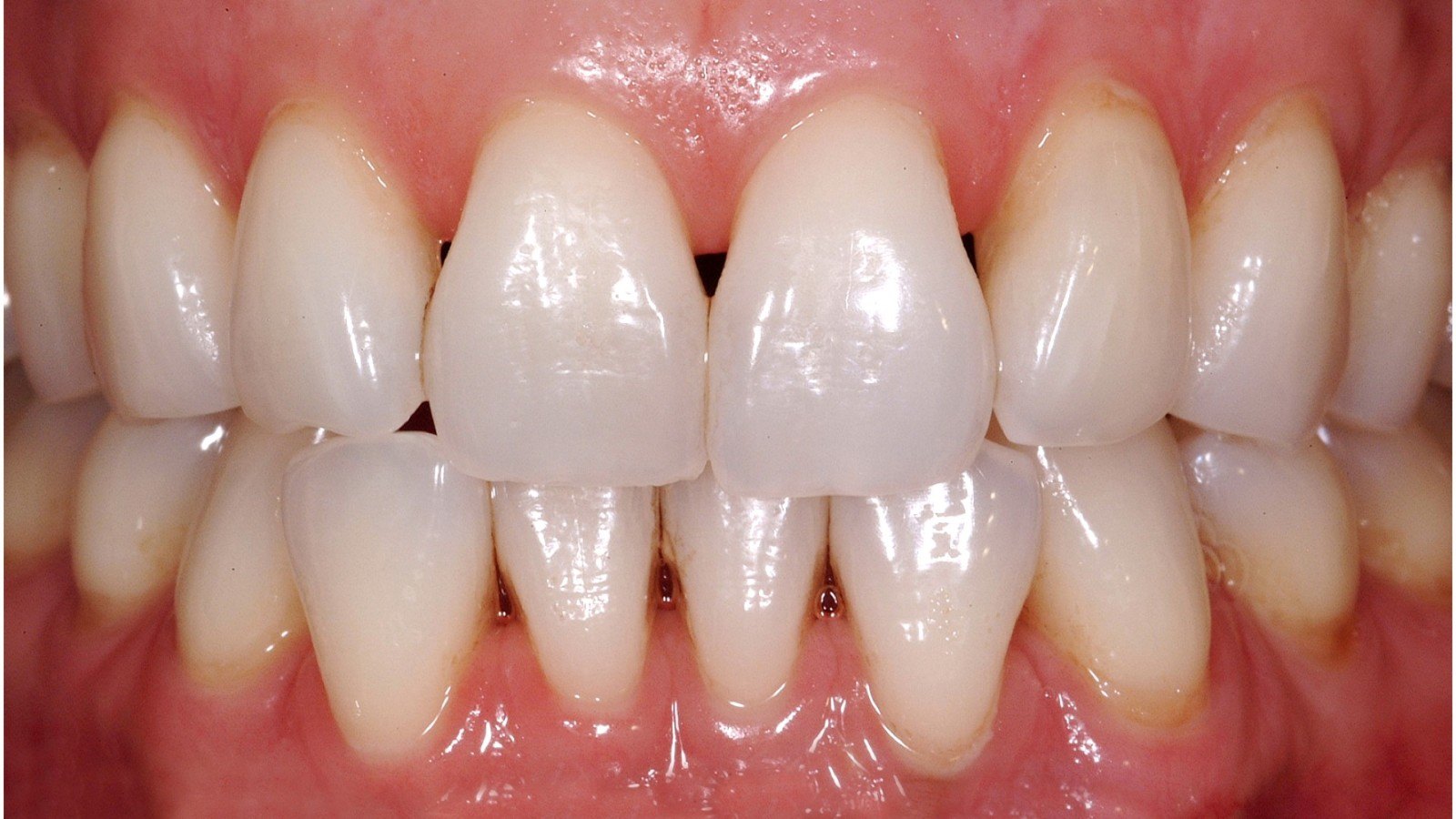 牙龈萎缩是怎么回事?