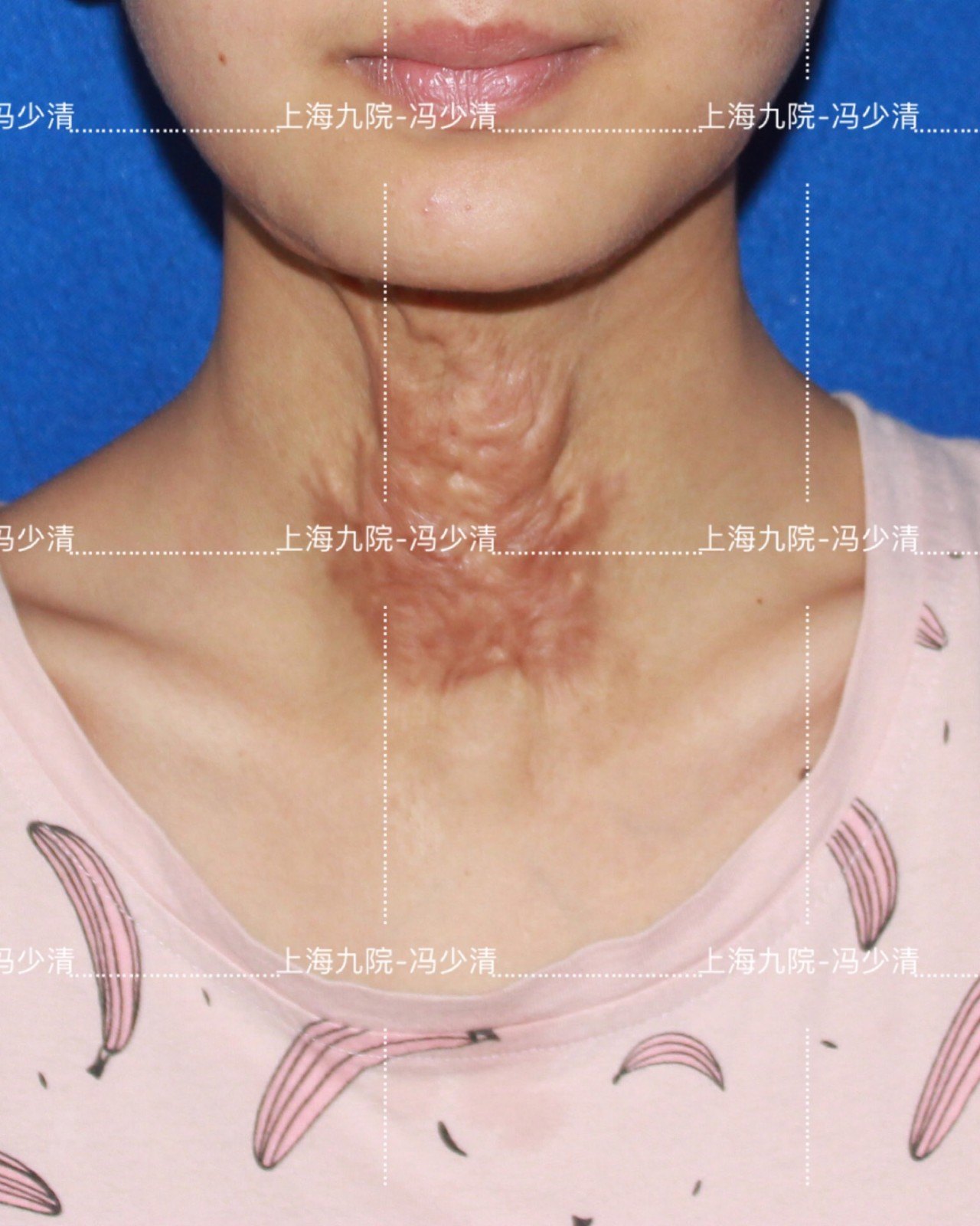 颈部瘢痕挛缩畸形的手术治疗