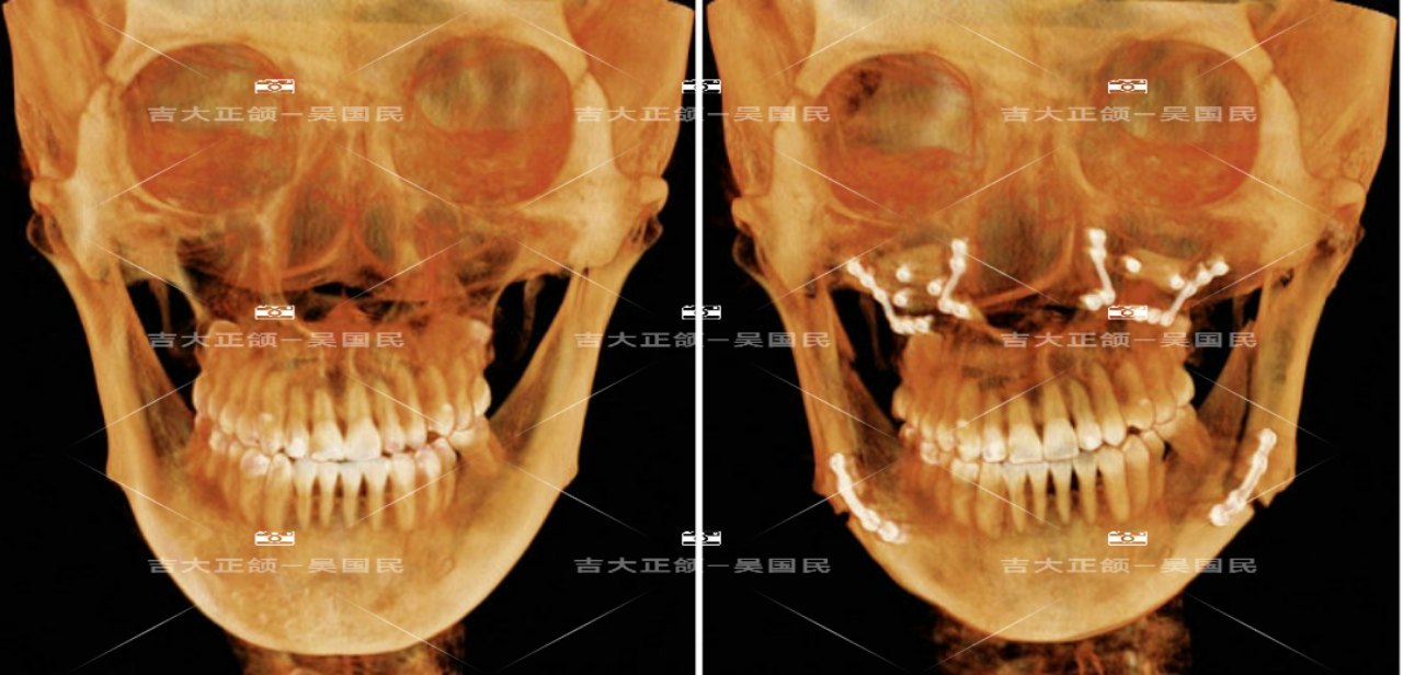 正颌 轮廓整形=美貌面型_牙颌畸形 好大夫在线