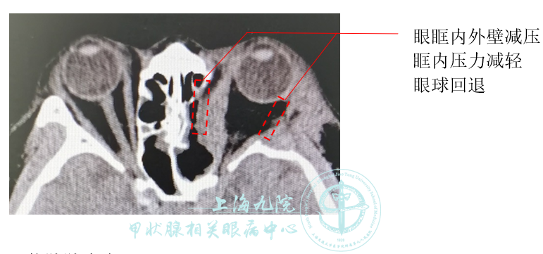 graves眼病系列病例⑤眼眶减压联合甲状腺切除手术