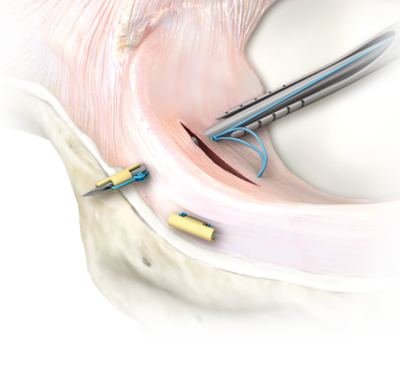 半月板缝合全内allinside技术解读