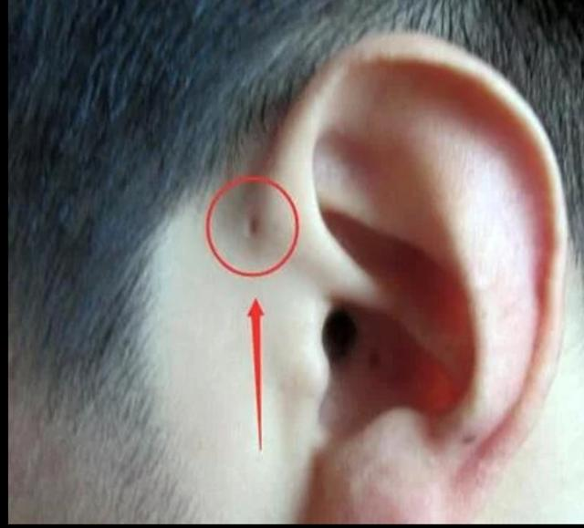 耳前小孔的秘密_先天性耳前瘘管_先天性耳前瘘管 - 好