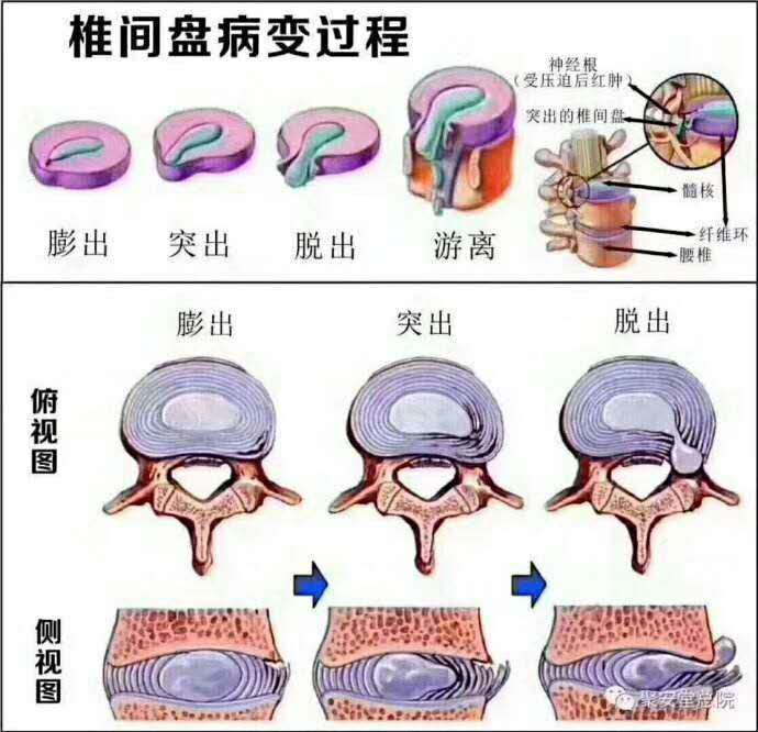 腰椎间盘突出后的30个常见问题之膨出,突出,脱出