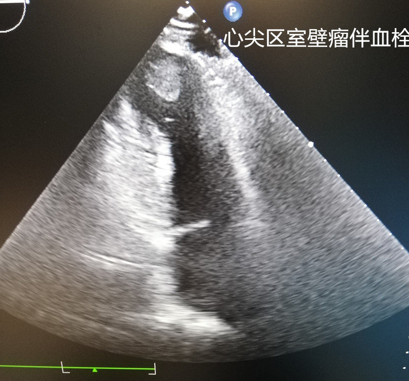 心室附壁血栓是心肌梗死后,由于局部心内膜发生炎症反应,心肌运动减弱