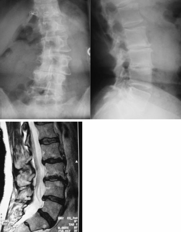 在脊柱侧凸畸形的邻近节段腰椎间盘置换