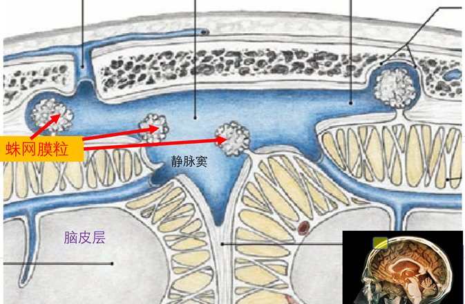 脑脊液循环的磁共振检查脑脊液电影