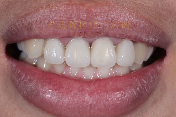 上前牙全瓷冠和全瓷贴面美容修复_好大夫在线