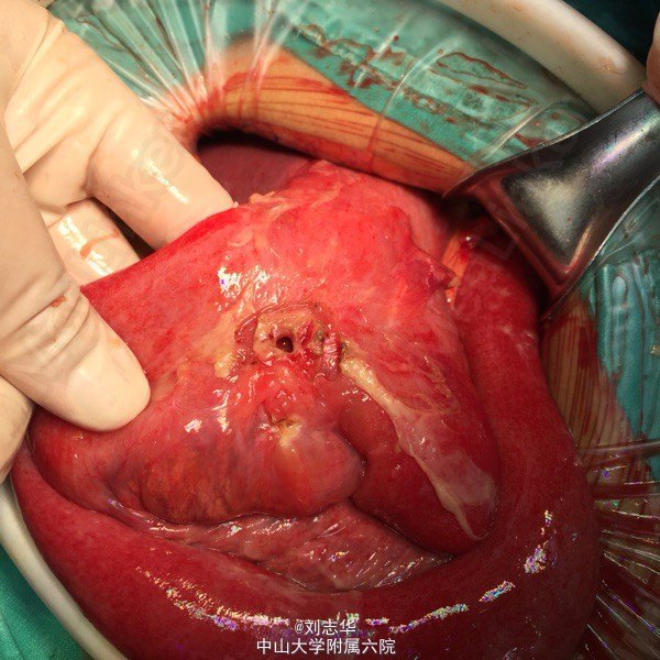 术中见胃肠吻合口下对应小肠系膜侧穿孔.大小约0.5cm.