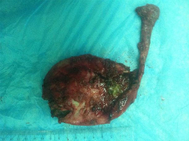 腹腔镜治疗囊肿型胆总管囊肿照片