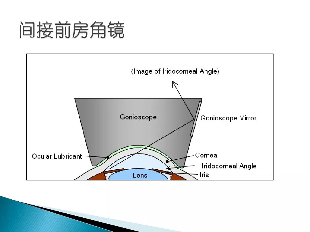 房角镜及三面镜检查