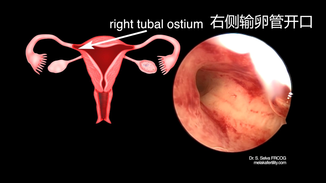 异常子宫出血,月经过多,月经稀少,月经周期改变,子宫肌瘤,子宫内膜