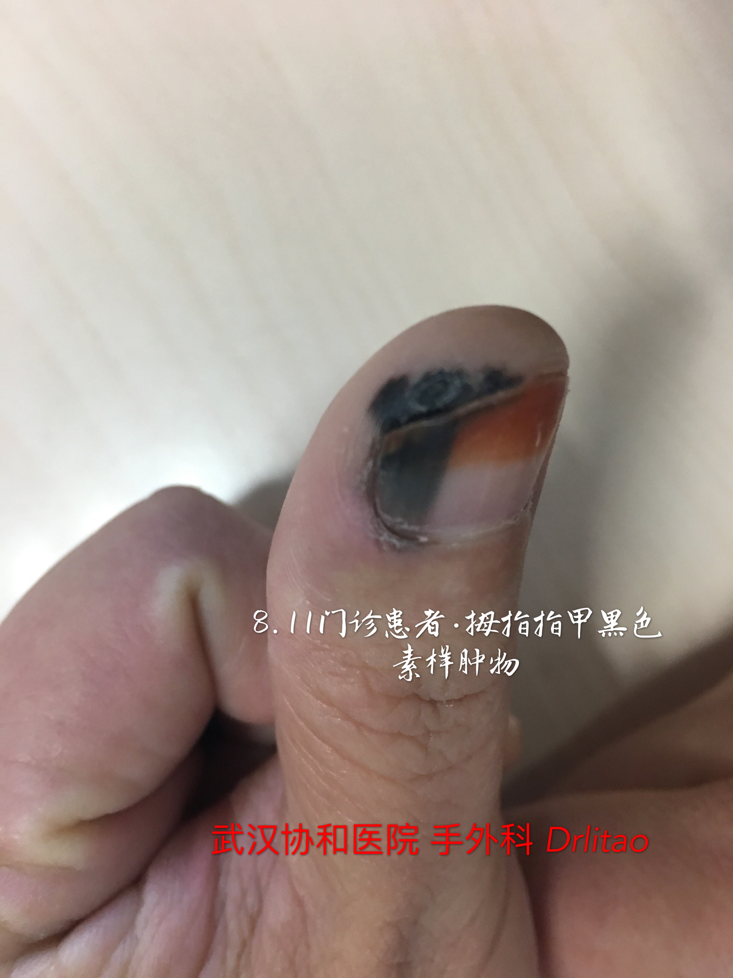 关于皮肤鳞癌恶性黑色素瘤皮肤痣指甲痣的区别