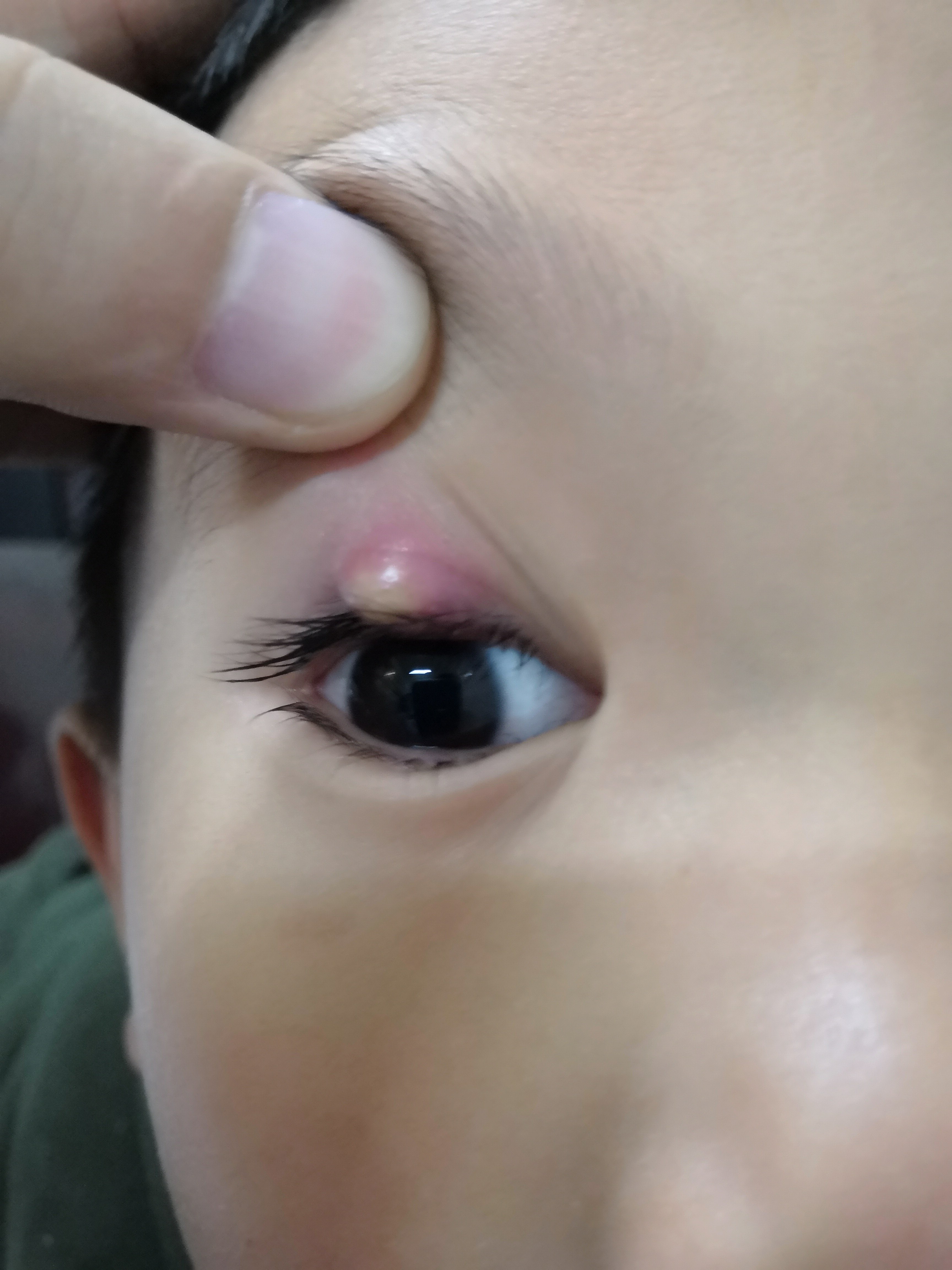 睑腺炎(俗称:麦粒肿,中医名:针眼)的个人经验治疗