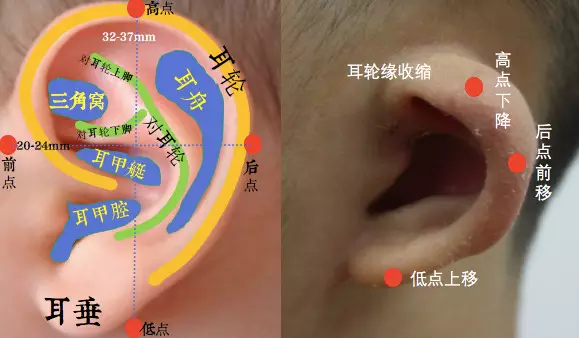 狒狒耳垂耳环缩耳耳轮畸形耳轮脚横突耳甲腔畸形隐耳可以在早期通过