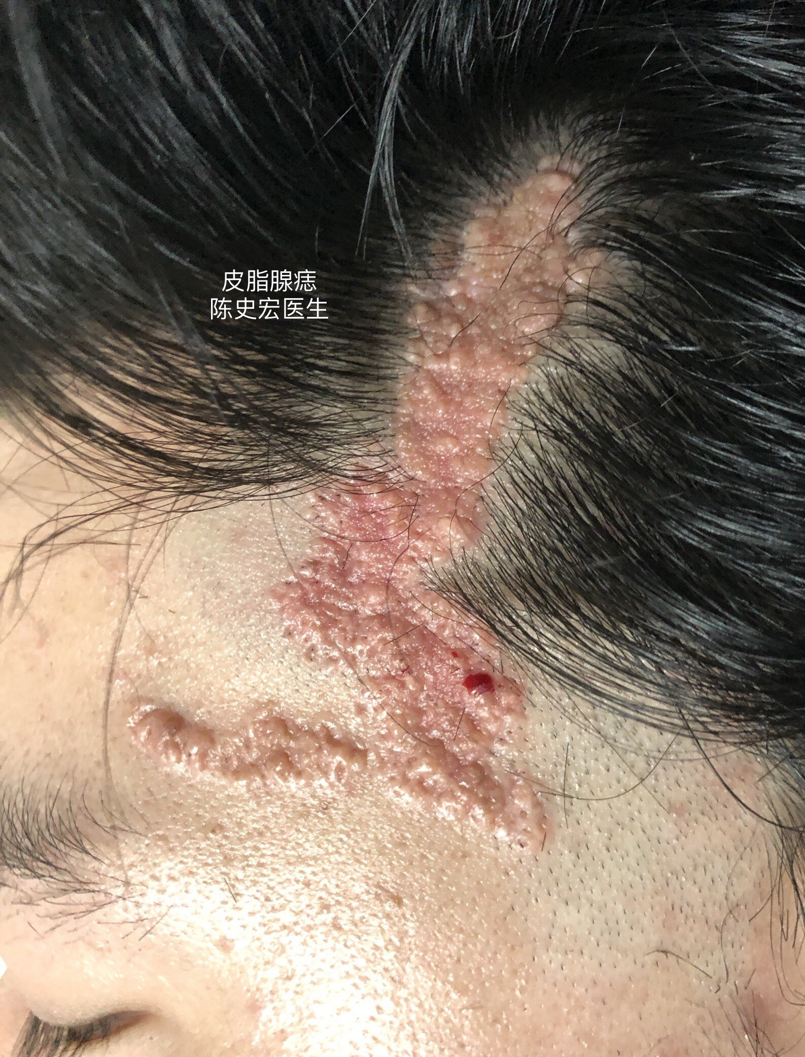 皮脂腺痣(案例)