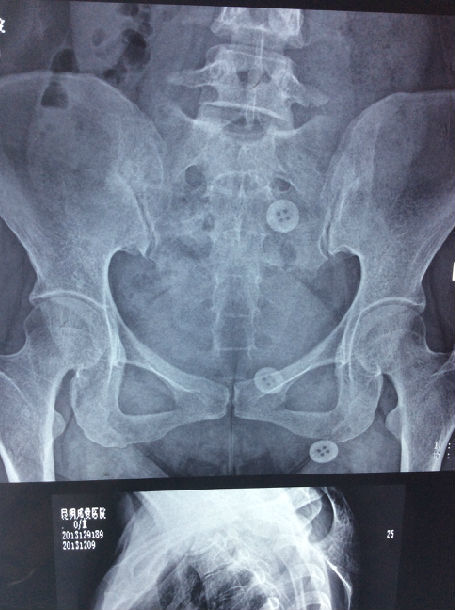 颈椎病导致上肢无力疼痛呼吸困难,祖传手法2周