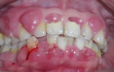 艾滋病日,牙医一定要给患者看,艾滋病的口腔表