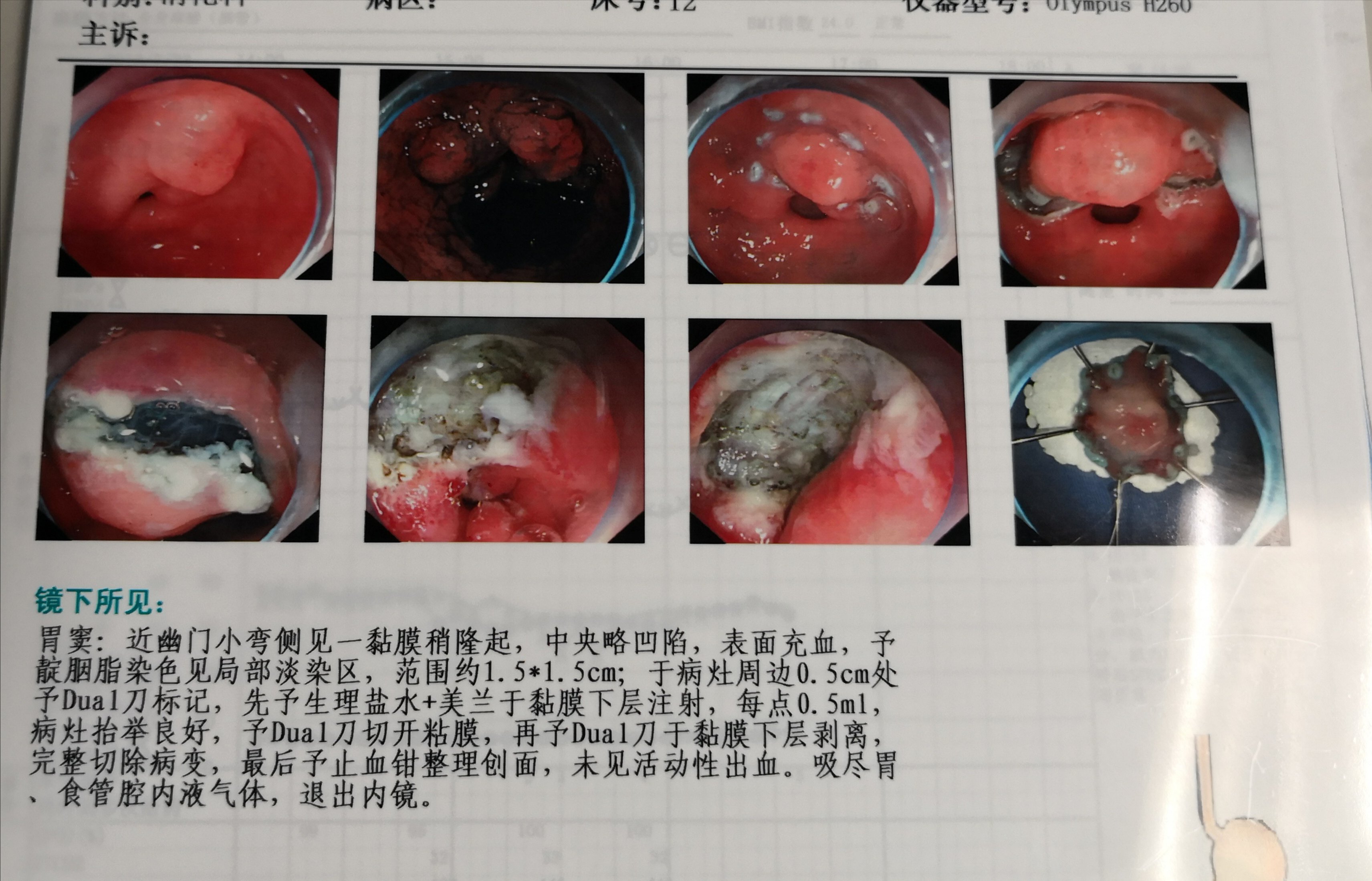 其实不是这样的,萎缩性胃炎患者有症状固然要复查,没有症状,也要注意