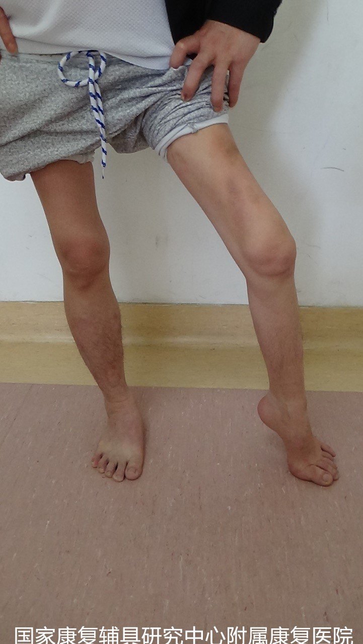 小儿麻痹引起的下肢畸形的手术治疗