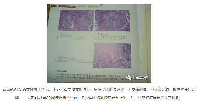 发生率可高达31%,有时镜下肉芽肿成堆,故有人叫浆细胞性肉芽肿,炎性