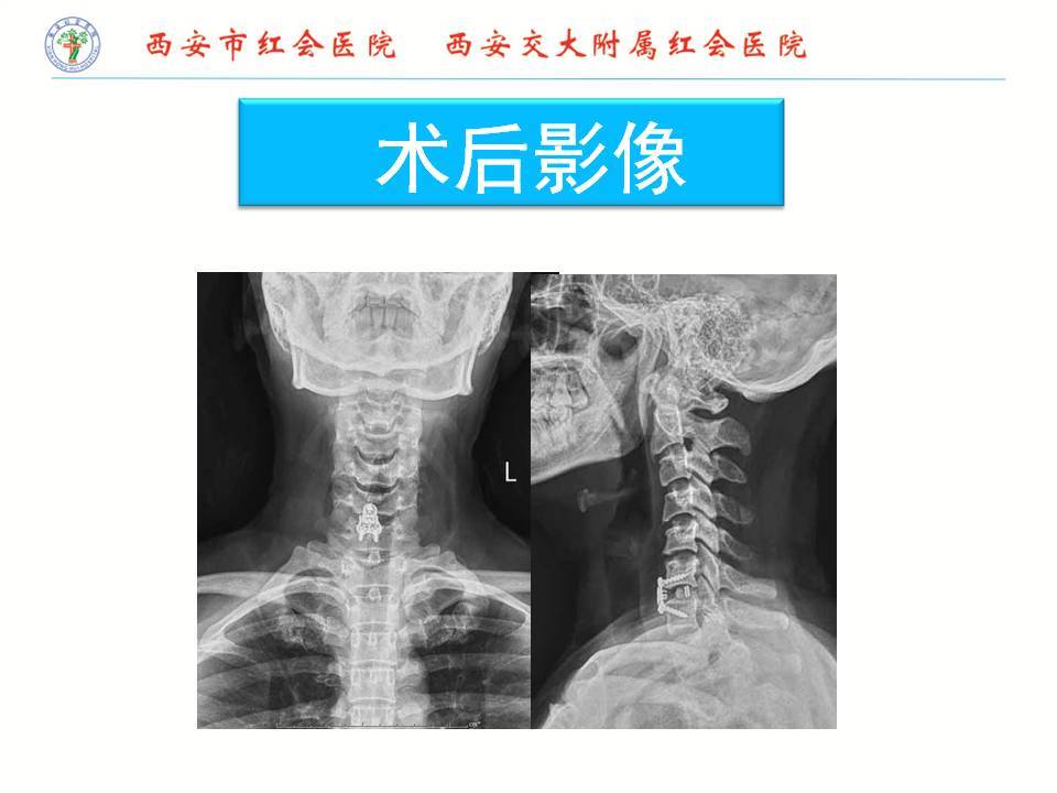 所以我们根据病情给他做了颈椎前路减压植骨融合内固定术.