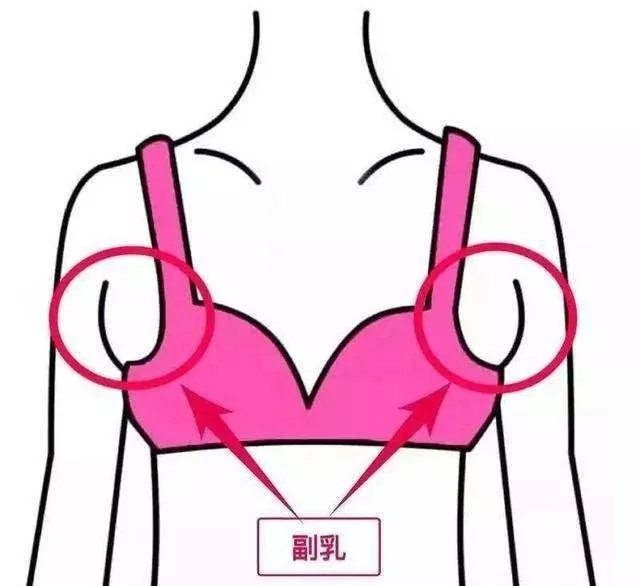 恼人的副乳该拿它怎么办