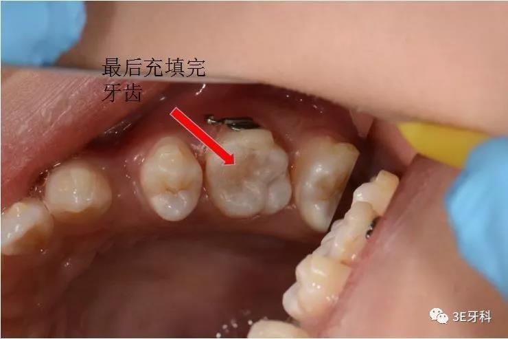 口腔中你看不见的虫牙窝沟龋