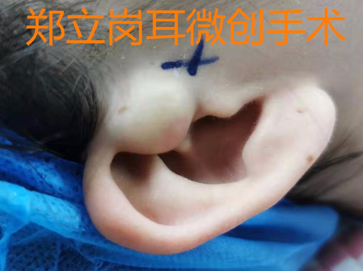 先天性耳前瘘管伴表皮样囊肿,罕见病例微创解决