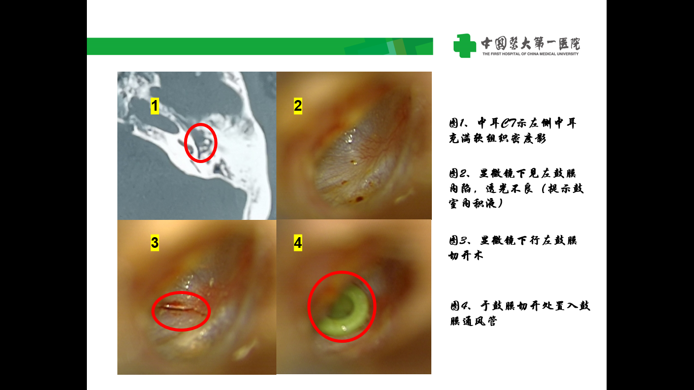 鼓膜置管术治疗分泌性中耳炎(手术视频)