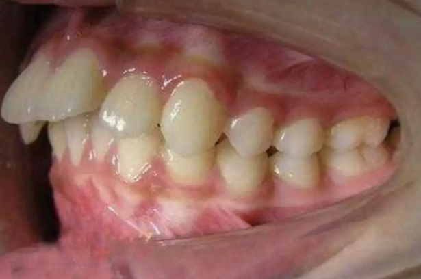 骨性龅牙不想做正颌手术可以吗
