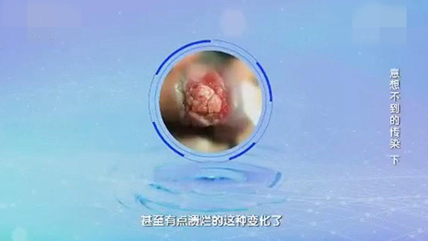 cctv-健康之路,意想不到的传染-----hpv,老婆宫颈病变