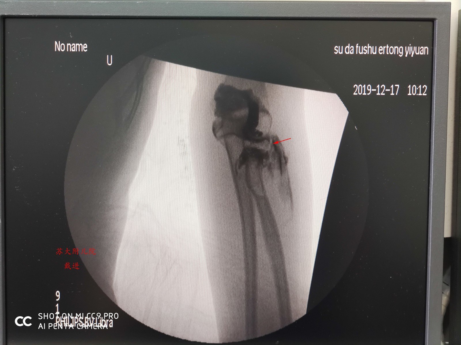 典型病例肘关节造影术在儿童桡骨近端骨折中的应用