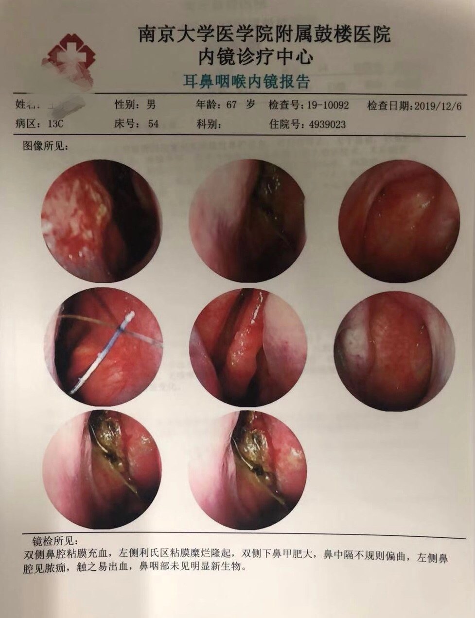 黏膜恶性黑色素瘤患者治疗新希望!