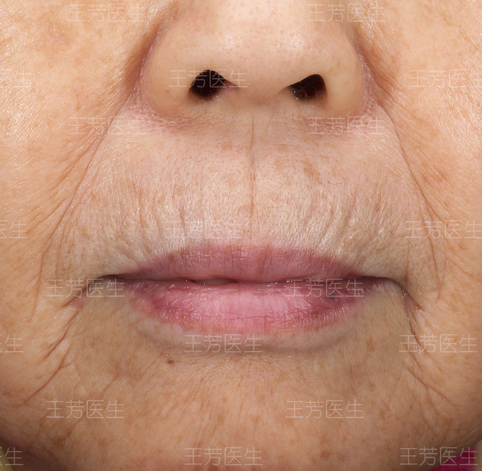 吹火纹或称"吸烟纹,是嘴唇周围的纵形皱纹,也是口周皮肤老化,弹性