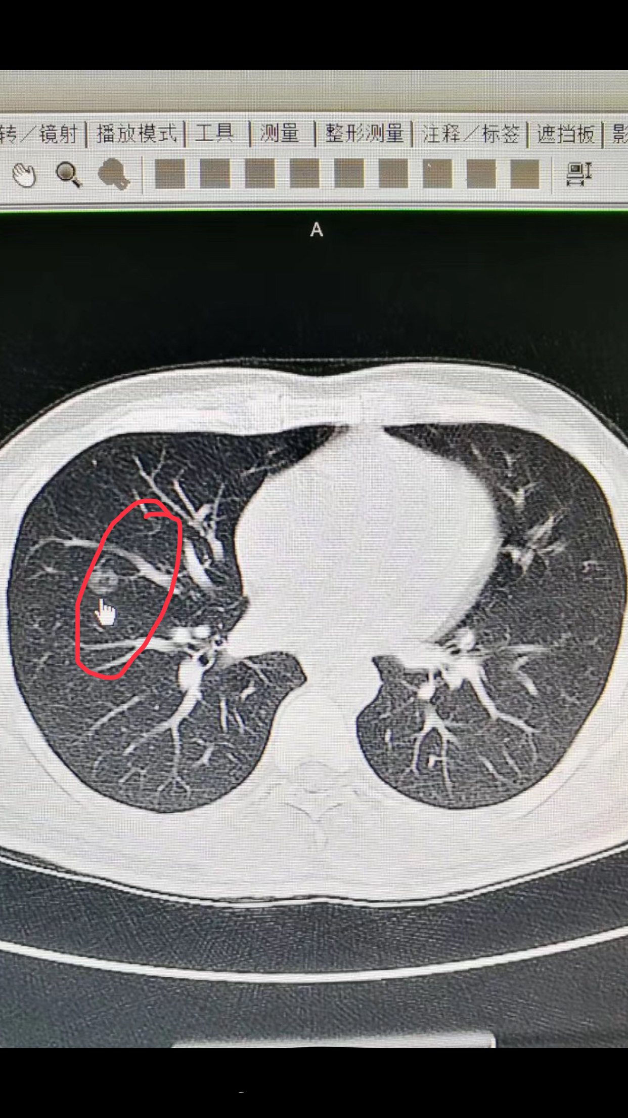 胸部薄层ct是早期发现早期肺癌的首选