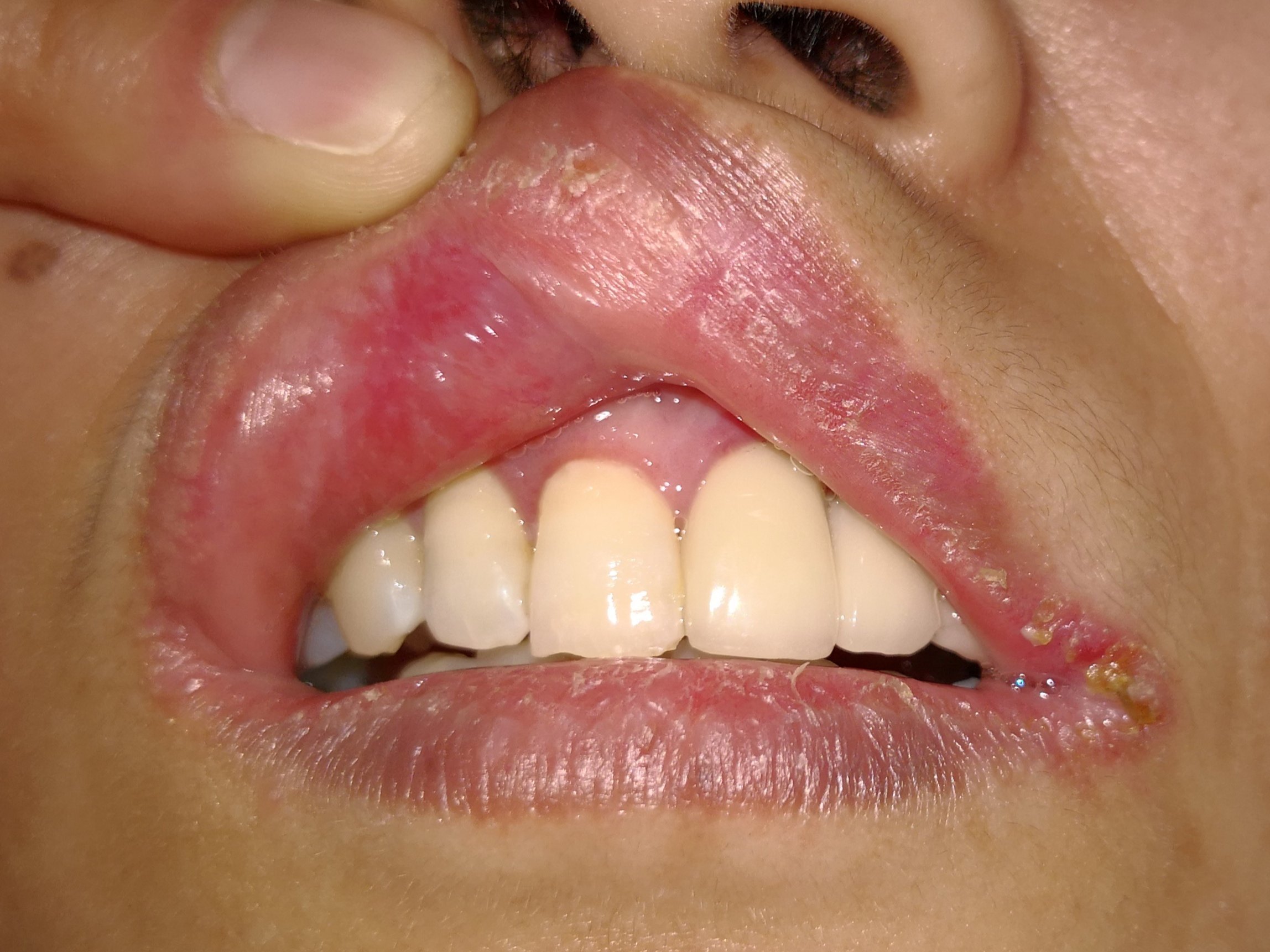 是人类最常见的口腔真菌感染