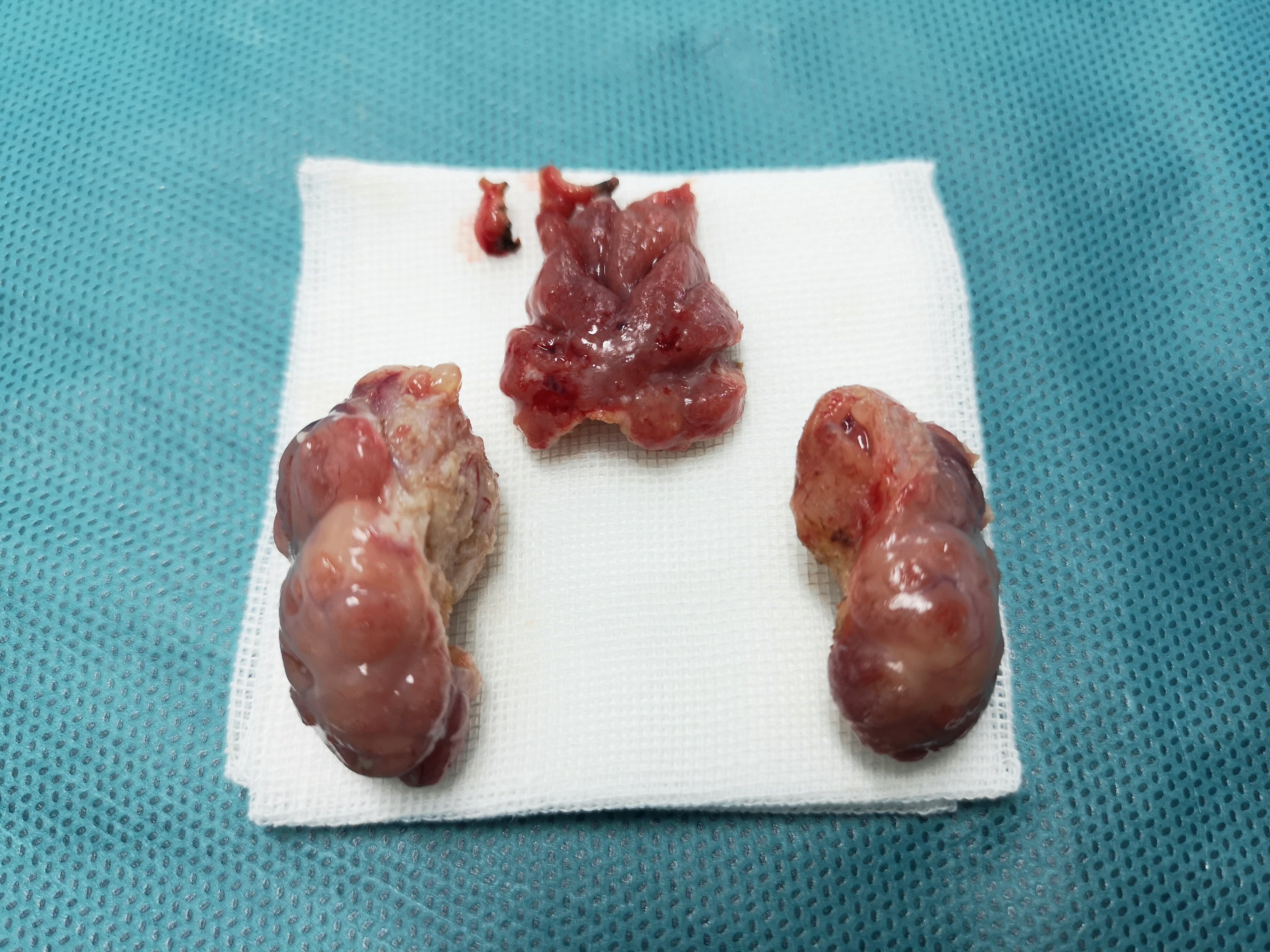 上方中间是完整肥大的腺样体,下方两侧是完整肥大的扁桃体.