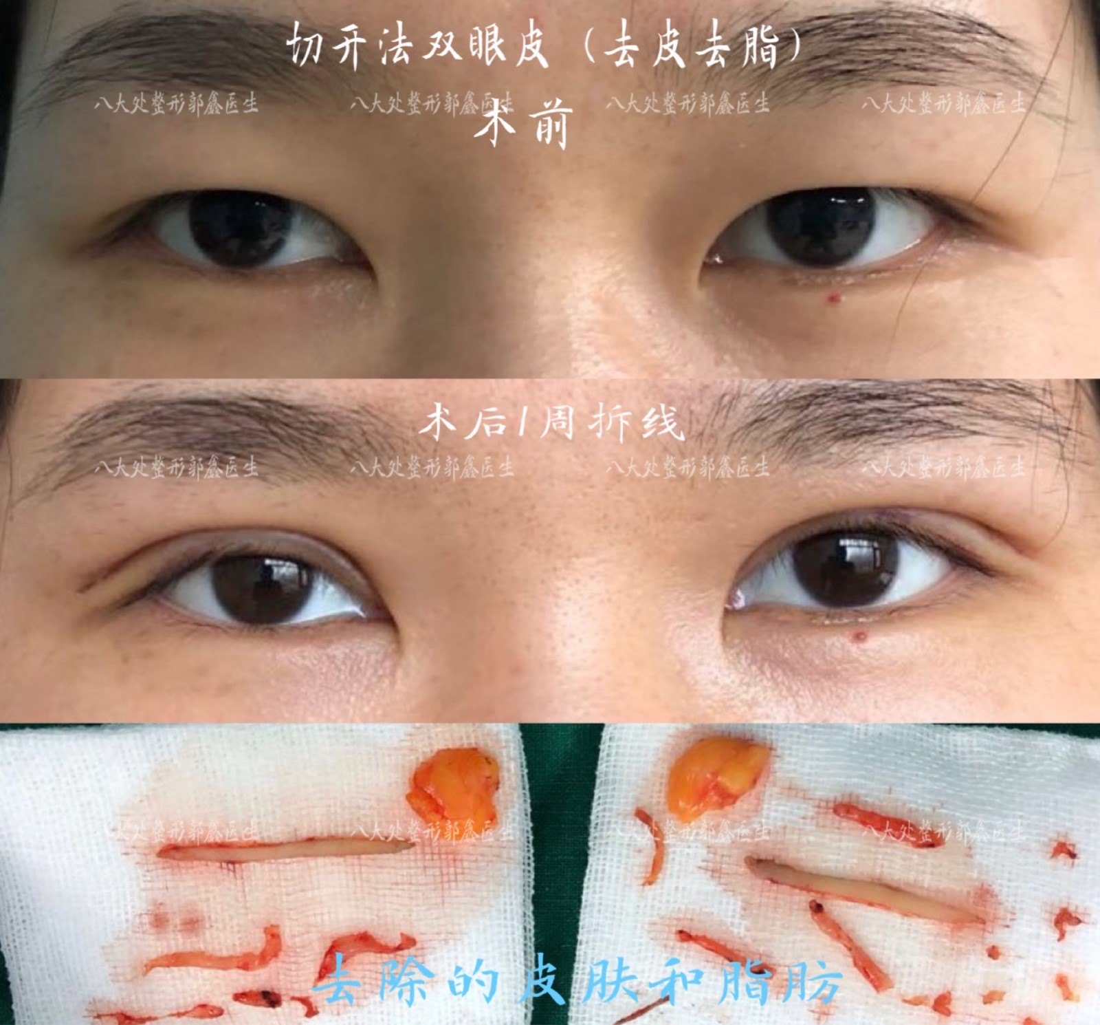 case 38 切开法双眼皮
