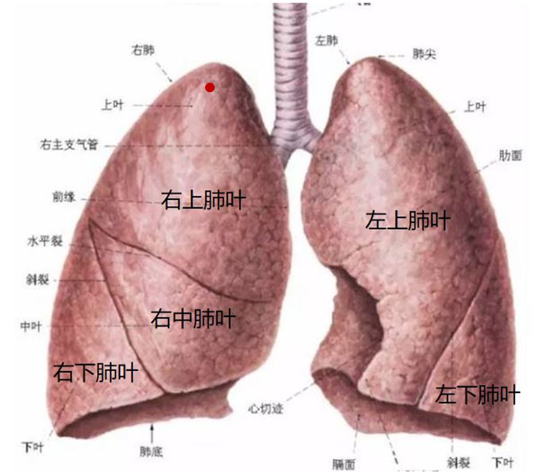      右上肺结节